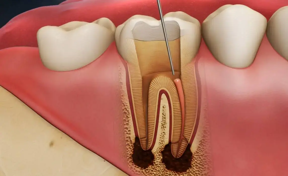 Endodonti (Kanal Tedavisi)